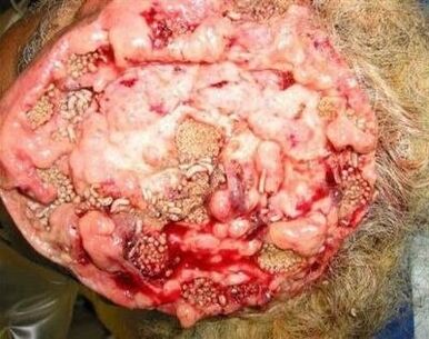 Parasiten im menschlichen Gehirn